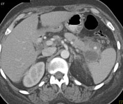 Splenic Artery Pseudoaneurysm - CTisus CT Scan