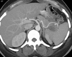 Splenic Artery Pseudoaneurysm - CTisus CT Scan