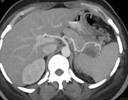 Splenic Artery Pseudoaneurysm - CTisus CT Scan