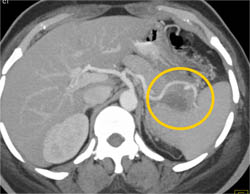 Splenic Artery Pseudoaneurysm - CTisus CT Scan