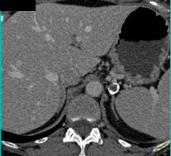 Splenic Artery Aneurysm - CTisus CT Scan