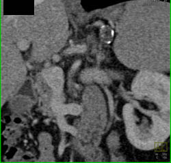 Splenic Artery Aneurysm - CTisus CT Scan