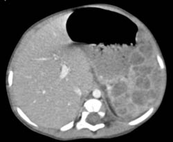 Splenic Hemangiomas - CTisus CT Scan