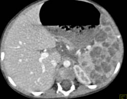 Splenic Hemangiomas - CTisus CT Scan