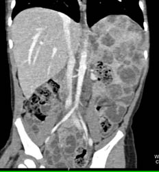 Splenic Hemangiomas - CTisus CT Scan