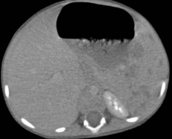 Splenic Hemangiomas - CTisus CT Scan