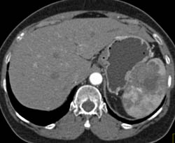 Splenic Lymphoma - CTisus CT Scan