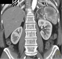 Splenic Lymphoma - CTisus CT Scan