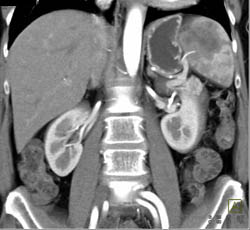 Splenic Lymphoma - CTisus CT Scan