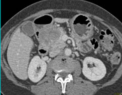 Splenic Lymphoma - CTisus CT Scan