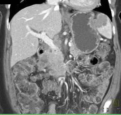 Splenic Lymphoma - CTisus CT Scan