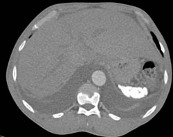 Sickle Cell Disease - CTisus CT Scan