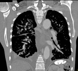 Sickle Cell Disease - CTisus CT Scan