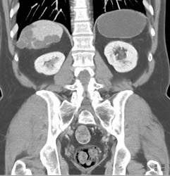 Implants on Liver But Spleen Not Involved With Mucinous Tumor - CTisus CT Scan