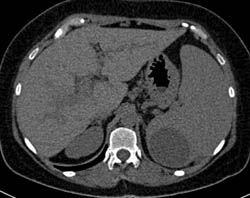 Splenic Cyst - CTisus CT Scan