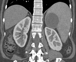 Splenic Cyst - CTisus CT Scan