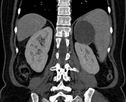 Splenic Cyst - CTisus CT Scan