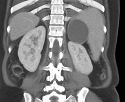 Splenic Cyst - CTisus CT Scan