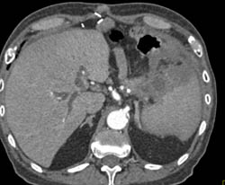 Splenic Abscess - CTisus CT Scan