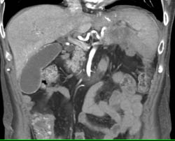 Splenic Abscess - CTisus CT Scan