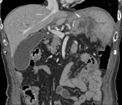 Splenic Abscess - CTisus CT Scan