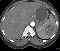 Splenic Hemangioma - CTisus CT Scan