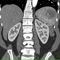 Splenic Hemangioma - CTisus CT Scan