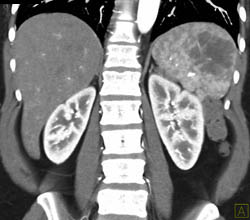 Splenic Hemangioma - CTisus CT Scan