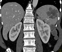 Splenic Hemangioma - CTisus CT Scan