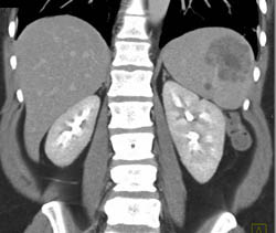 Splenic Hemangioma - CTisus CT Scan