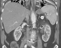 Splenic Artery Aneurysm - CTisus CT Scan