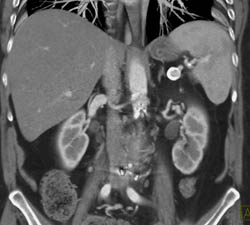 Splenic Artery Aneurysm - CTisus CT Scan