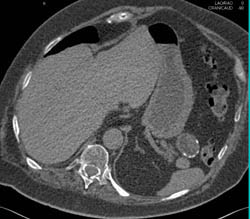 Splenic Artery Aneurysm - CTisus CT Scan