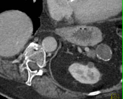 Splenic Artery Aneurysm - CTisus CT Scan