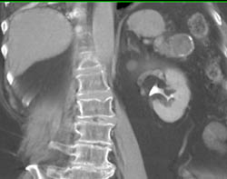 Splenic Artery Aneurysm - CTisus CT Scan