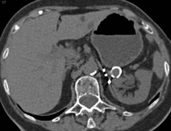 Splenic Artery Aneurysm - CTisus CT Scan