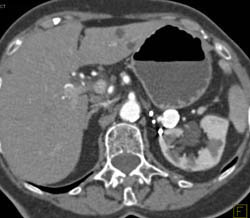 Splenic Artery Aneurysm - CTisus CT Scan