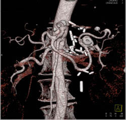 Splenic Artery Aneurysm - CTisus CT Scan