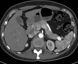 Splenic Artery Aneurysm Simulates An Islet Cell - CTisus CT Scan