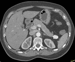 Splenic Artery Aneurysm - CTisus CT Scan