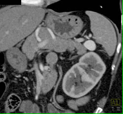 Splenic Artery Aneurysm - CTisus CT Scan