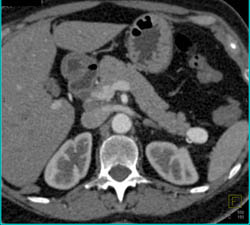 Splenic Artery Aneurysm - CTisus CT Scan