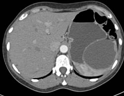 Splenic Cyst - CTisus CT Scan