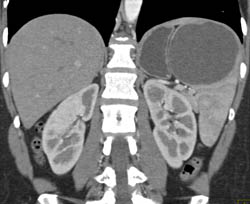 Splenic Cyst - CTisus CT Scan