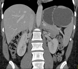 Splenic Cyst - CTisus CT Scan