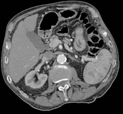 Sarcoidosis - CTisus CT Scan