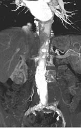 Sarcoidosis - CTisus CT Scan