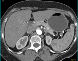 Sarcoidosis - CTisus CT Scan