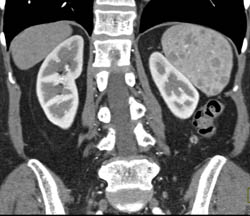 Sarcoidosis - CTisus CT Scan