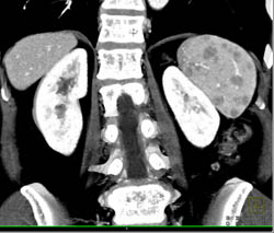 Sarcoidosis - CTisus CT Scan